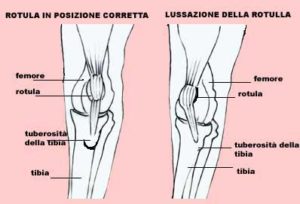 lussazione mediale della rotula